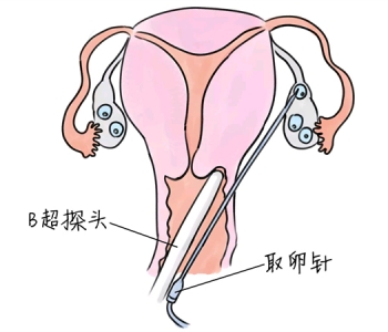 小儿退烧推拿手法 5种徐州捐卵宝宝退烧按摩方法